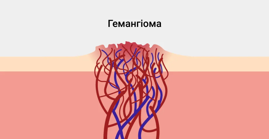 Chto-takoe-gemangioma?