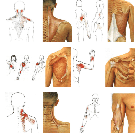 Что такое триггерные точки? Как диагностировать и лечить?
