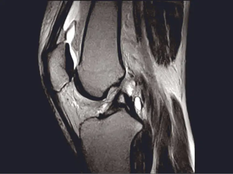 Снимки томография колена