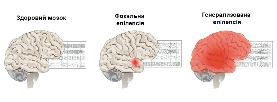 Епілепсія: діагностика, симптоми та лікування
